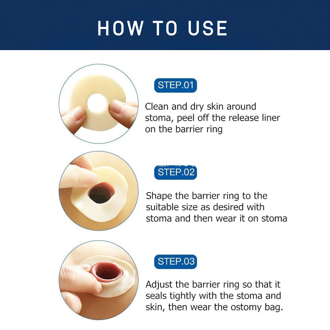 Ostomy Barrier Rings-Outer Diameter: 2